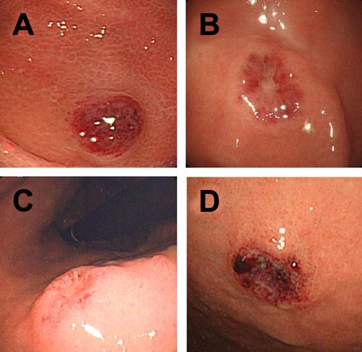 Figure 1. Gross appearance of LyGa. Cases 3 (A), 3 (B), 4 (C), and 10 (D) are shown.