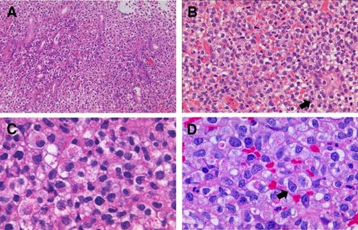 Figure 2. Histopathology of LyGa. The pattern of infiltration is diffuse (A; case 1; 20× objective). Atypical NK cells occasionally infiltrate the glandular epithelium (arrow), showing lymphoepithelial-like lesions by NK cells (B; case 10; 40× objective). Some atypical cells harbor large eosinophilic granules in the cytoplasm (C; case 3; 100× objective). In some cases, the nucleoli are prominent (arrow; D; case 5; 100× objective). Figures were taken with a microscope (BX51; Olympus) and a digital camera (KY-F75; Victor). Microsoft PowerPoint 2007 was used for image processing. Numeric apertures: 20×/0.40 (A), 40×/0.75 (B), 40×/0.95 (C), 60×/0.90 (D).