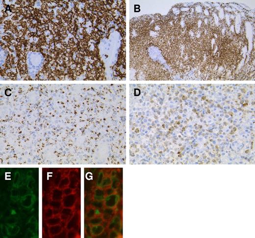 Figure 3. Immunophenotype of LyGa by immunohistochemistry. The atypical cells are positive for CD7 (A; case 5), CD56 (B; case 3), granzyme B (C; case 4), and cytoplasmic CD3ϵ (D; case 2). To confirm the cytoplasmic localization of CD3ϵ, fluorescein double immunohistochemistry for CD3ϵ (E) and CD56 (F) was performed (case 10). In the merged figure (G), the cytoplasmic localization of CD3ϵ is clearly shown, indicating that the atypical cells are of NK lineage. Figures were taken with a microscope (BX51; Olympus) and a digital camera (KY-F75; Victor). Microsoft PowerPoint 2007 was used for image processing. Numeric apertures: 40× (A,C,D), 10× (B), 60× (E-G).