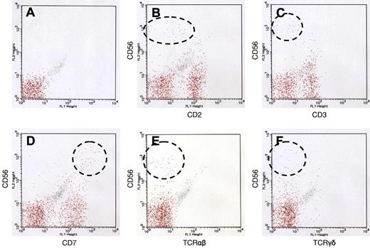 Figure 4. Immunophenotype of LyGa by flow cytometry. Flow cytometry was performed for case 5. The atypical cells were CD56bright, CD2dim (B), CD3− (C), CD7bright (D), TCRαβ− (E), and TCRγδ− (F). (A) Negative control.