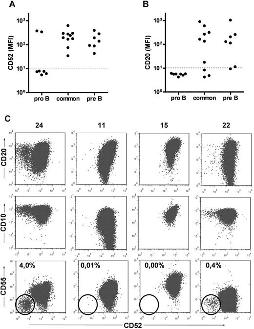 Figure 1. Expression of CD52 and CD20 in primary ALL and detection of GPI-defective cells. Twenty-four ALL samples taken at diagnosis were analyzed by flow cytometry. (A) Expression of CD52 according to subtype. The dotted line represents the fluorescence intensity of isotype controls. (B) Expression of CD20 according to subtype. (C) Top: Expression of CD52 and CD20 within double-positive cases (patients 11, 15, 23, and 24). In 11 of 19 cases in which the bulk of the cells expressed CD52, distinct CD52− subpopulations were detected. Middle: CD52− cells express CD10, indicating their leukemic origin. Bottom: CD52− cells show concurrent loss of CD55, indicating a GPI-defective phenotype.