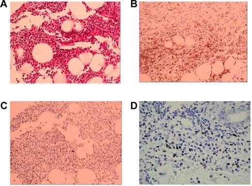 Figure 1. Pathologic features of the skin biopsy from patient 2. (A) Atypical T lymphocyte infiltration (hematoxylin-eosin stain; original magnification 20×10). (B) Immunohistochemistry stain shows tumor cells expressing CD3 (original magnification 20×10). (C) Immunohistochemistry stain shows tumor cells expressing TIA-1 (original magnification 20×10). (D) In situ hybridization of EBV-RNA.