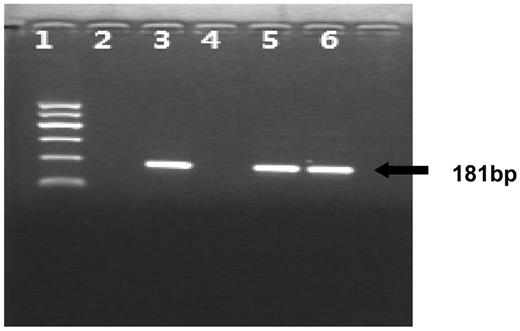 Figure 2. Nested PCR for the identification of the SRY gene in the mothers. (Lane 1) Molecular weight marker; (lane 2) without template (negative control); (lane 3) DNA sample from a male (positive control); (lane 4) DNA sample from a female without pregnancy (negative control); (lane 5) DNA sample from the mother of patient 1; (lane 6) DNA sample from the mother of patient 2.