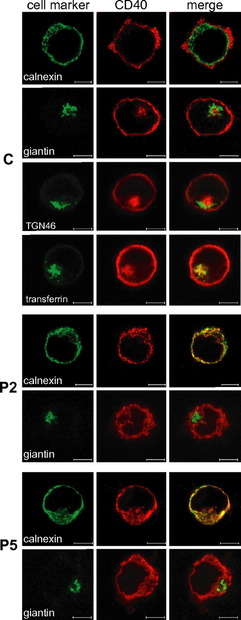 Figure 4. Localization of CD40 mutants in the ER. Intracellular double staining of CD40 (AlexaFluor568) with either calnexin, an ER marker (AlexaFluor488), or giantin, a Golgi Apparatus marker (AlexaFluor488-conjugate), in BLCLs from control (C) and from P2 and P5 patients. A further double staining was performed on C either with TGN46, a Trans Golgi Network marker (AlexaFluor488), or after cell incubation with fluorescently labeled transferrin (AlexaFluor488-conjugate) that localizes to the recycling endosomal compartment. Colocalization is visible as yellow staining in the merged micrographs. Scale bars, 5 μm. Analysis was performed by the LSM510META confocal microscope (Zeiss) with a EC Plan-Neofluar 100×/1.30 oil objective and a scan zoom of 1-1.5 ×. Digital images were analyzed with the LSM Image Browser (Zeiss) and processed with Adobe Photoshop 6.0 (Adobe Systems).