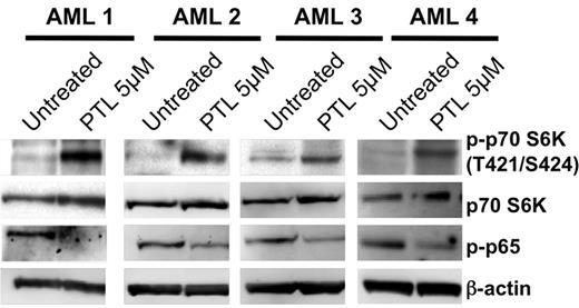 Figure 2. Activation of the PI3K/mTOR pathway in response to PTL. Representative immunoblot analyses for 3 primary AML specimens treated with 5μM PTL for 6 hours. Blots were probed as indicated with antibodies against either phospho-p70 S6 kinase (T421/S424), total p70 S6 kinase, phospho-p65 (S536), or β-actin.