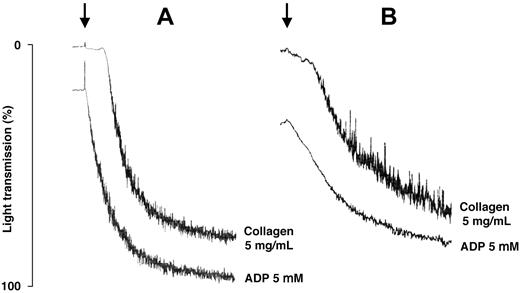 Figure 2. Tracings of in vitro platelet aggregation obtained at the end of eltrombopag treatment in patients with mutations of MYH9 protein affecting the tail or the motor domain of the molecule. (A) Mutations of MYH9 protein affecting the tail (patient no. 5 in Table 2). (B) Mutations of MYH9 protein affecting the motor domain of the molecule (patient no. 1). Arrows indicate the addition of the stimulating agents reported beside the tracings.