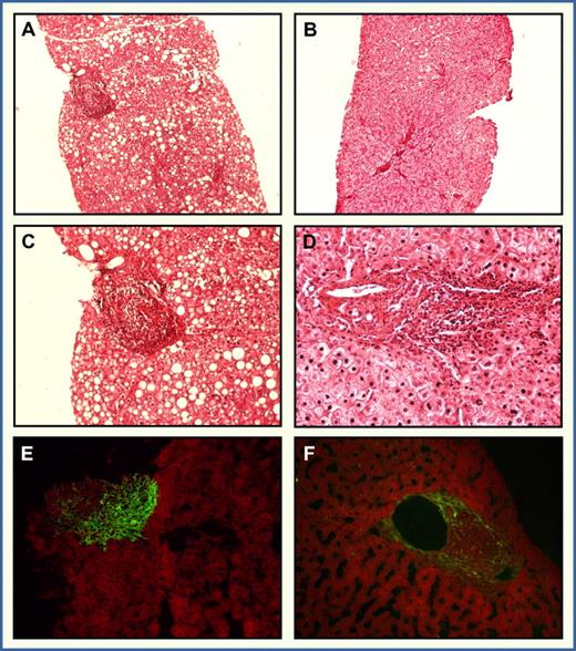 Figure 5. Low (20×/0.40) and high (63×/0.75) magnification of liver histology before PIRR therapy and after the follow-up period from a responsive MC patient (female, 59 years). (A,C) Basal liver biopsy and (B,D) pictures from the second liver biopsy taken 3 years after the end of the treatment. Note a significant decline of inflammatory cells either in portal tract or in parenchyma. A sharp regression of hepatocyte fat degeneration was also noticed. In situ detection of CD20 protein with direct immunofluorescence was carried out in the first (E) and in the second (F) liver biopsy. A remarkable decline of CD20+ cells was demonstrated after PIRR therapy. Slides were viewed with a Leica DMBL research microscope using N-PLAN lens. Images were acquired using a Leica camera model DFC 490 and were processed with Leica application Version 2.4.OR1 (Leica Microsystems).