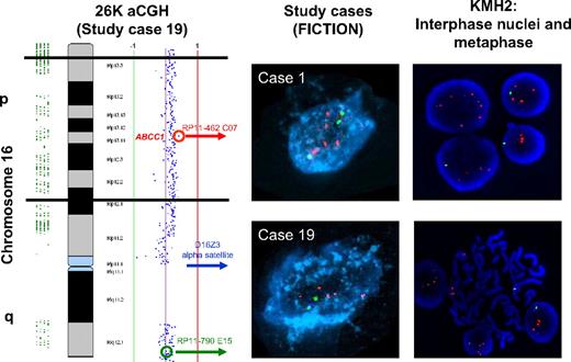 Figure 3. Minimally gained region on chromosome 16p (chr16: 1 480 000 - 26 000 000) is shown demarcated by the black bars. On the left side a representative profile with 16p gain is demonstrated (study case 19) showing overrepresentation of chromosomal material in the tumor DNA as a shift (at the BAC level) to the right from the neutral line. FISH validation of the finding is shown in the right panel with the use of probes derived from BAC clones: top left, study case 1 (interphase); bottom left, study case 19 (interphase); top right, KMH2 (interphase); and bottom right (metaphase). The red signal spans the ABCC1 locus on 16p; as references, a locus on 16q and a centromere 16 probe were used. FICTION: CD30 stain in light blue. Relative signal number gains of the ABCC1 locus are demonstrated.