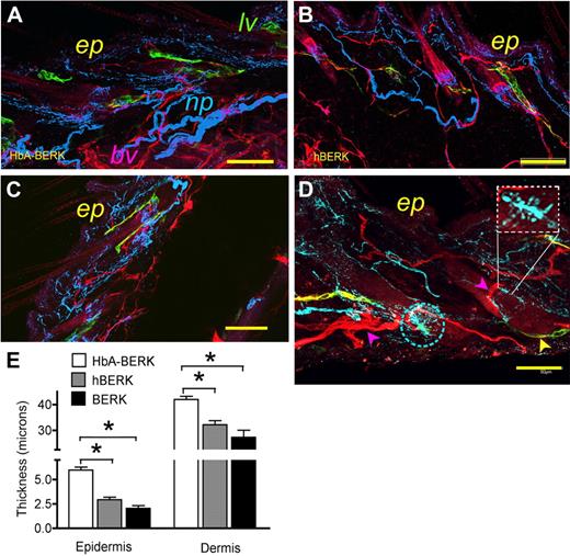 Figure 5. Laser scanning confocal microscopy and immunofluorescent microscopy of skin from male hBERK1 and matched HbA-BERK mice. (A-D) A montage of overlapping fields of Z-stack images (each 2.5-μm-thick) of 80- to 100-μm-thick sections of skin in HbA-BERK (A), hBERK1 (B), and BERK (C-D), showing vascular, lymphatic, and nerve architecture. Image shows CD31+ blood vessels (pseudo-colored red), PGP 9.5 immunoreactive nerves (pseudo-colored blue), and LYVE1+ lymphatic vessels (pseudo-colored green). Bar represents 250 μm (A-C) and 50 μm (D). The rectangular inset in panel D shows an enlargement of sprouting of nerve fibers, also seen in the encircled area. ep indicates epidermis; lv, lymphatic vessels; and np, nerve plexus. Each image represents 3 reproducible and similar images. Image acquisition information: FluoView FV1000 Laser Scanning Confocal BX61 Microscope (Olympus); 20×/0.70 (A-C), 40×/1.35 (D) oil objective lenses; In-built image acquisition system; Adobe Photoshop. (E) Morphometric analysis of epidermal and dermal thickness performed on hematoxylin and eosin-stained skin sections (shown in supplemental Figure 3; original magnification ×200) by substituting 1 unit for 0.5 μm as per the calibration of the micrometer. Data are shown as mean ± SEM of 9 measurements of 3 separate sections from 3 different mice. □ represents HbA-BERK mice; , hBERK1 mice; and ■, BERK mice. *P < .01.
