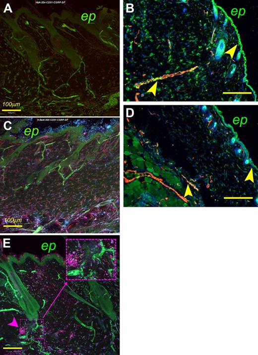 Figure 6. A montage of overlapping fields of z-stack images (each 2.5-μm-thick) of 80- to 100-μm-thick sections of skin showing the expression of mediators of pain in skin. HbA-BERK (A), hBERK1 (C), and BERK (E). Image shows CD31+ blood vessels (pseudo-colored green), SP immunoreactivity (pseudo-colored red), and CGRP immunoreactivity (pseudo-colored blue). Magenta color in panels C and E is indicative of colocalization of CGRP (blue) and SP (red). The inset in panel E shows localized, dense immunoreactivity for SP in BERK mice. Bar represents 100 μm. ep indicates epidermis. (B,D) Coexpression of MOR and CD31+ on blood vessels in HbA-BERK (B) and hBERK1 (D) mice. Image shows CD31+ blood vessels (pseudo-colored red), MOR immunoreactivity (pseudo-colored green), and 4,6-diamidino-2-phenylindole+ nuclei (pseudo-colored blue). Yellow represents coexpression of MOR on blood vessels. Original magnification ×150; scale bar represents 250 μm. Arrows indicate MOR expression in the epidermis and vasculature. ep indicates epidermis. Each figure is representative of images from skins of 3 different mice. Image acquisition information: FluoView FV1000 Laser Scanning Confocal BX61 Microscope (Olympus), 20×/0.70 oil objective lens, In-built image acquisition system, Adobe Photoshop (panels A,C,E); Olympus IX70 microscope, 15×/0.45 objective lens, DP70 digital camera and DP70 Manager software (Olympus), Adobe Photoshop (panels B,D).