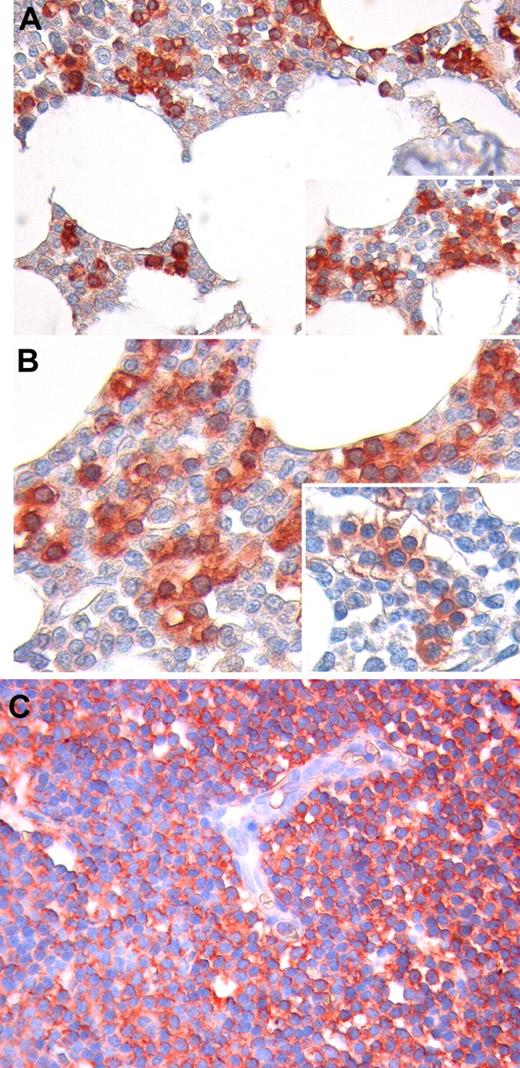 Figure 4. Immunohistochemical staining for Ang2 protein in BM and LN biopsies. In BM, Ang2 immunoreactivity is mainly confined to infiltrating CLL cells (red), whereas other hematopoietic cells are mostly negative or slightly reactive (light pink; A-B). Notably, Ang2 expression is detected also in CLL cells displaying an intravascular distribution. No significant staining for Ang2 is observed on stromal and endothelial cells (A-B insets). Neoplastic cells diffusely effacing LN architecture display a clear positivity to Ang2, and such a reactivity does not involve endothelia (C). Original magnification, 200× for panels A and C, 400× for panel B.