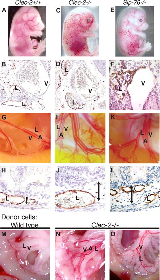 Figure 3. CLEC-2 is required in blood cells for normal lymphatic vascular development. (A-L) Clec-2−/− animals exhibit blood-lymphatic vascular mixing phenotypes. (A-F) Clec-2−/− embryos exhibit blood-filled lymphatics like those of Slp-76−/− animals during mid-gestation. Whole embryo images show blood-filled cutaneous lymphatics and edema (above). Transverse sections show anti-LYVE-1 immunostaining (brown) of lymph sacs adjacent to the cardinal vein (below). (G-L) Clec-2−/− neonates exhibited blood-filled mesenteric vessels (G,I,K) and edema of the intestine wall (H,J,L) like those of Slp-76−/− animals. (M-O) Blood-filled mesenteric lymphatic vessels arise in lethally irradiated wild-type mice after reconstitution with Clec-2−/− (N-O) but not wild-type (M) donor hematopoietic cells. A indicates artery; V, vein; and L, lymphatic.