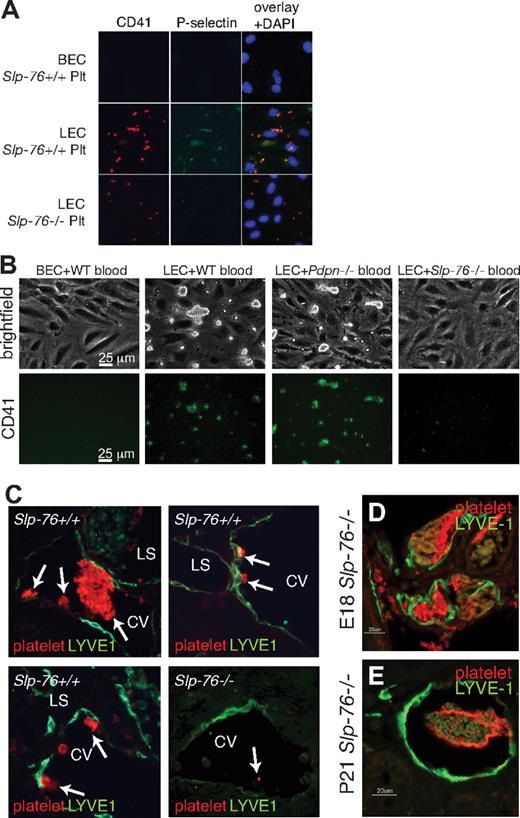 Figure 5. Platelets are activated by and form aggregates on LECs in a SLP-76–dependent manner in vitro and in vivo. (A) Wild-type platelets bind and are activated on the surface of LECs but not BECs. Slp-76−/− platelets adhere to LECs but do not form aggregates or express P-selectin. CD41 staining identifies platelets, and P-selectin expression identifies activated platelets. (B) Flow of heparinized wild-type blood at a shear level of 8 dynes/cm2 results in platelet aggregate formation on LECs but not on BECs (left 2 panels). PDPN-deficient platelets adhere and form aggregates on LECs, but SLP-76–deficient platelets fail to form aggregates (right 2 panels). Platelets are visualized with Alexa Fluor 488–conjugated anti-CD41 antibody after 5 minutes of flow. (C) Identification of platelet aggregates on LYVE-1+ LECs in Slp-76+/+ but not Slp-76−/− developing embryos. Immunostaining of E11.5 transverse embryo sections with antibodies against platelets (red) and the LEC LYVE-1 protein (green) are shown. Arrows indicate platelet aggregates on the endothelial cell surface. CV indicates cardinal vein; and LS, lymph sac. (D-E) Injection of wild-type platelets into Slp-76−/− animals results in the formation of platelet aggregates on the surface of LECs. Wild-type platelets were injected into the vitelline vein of E18 Slp-76−/− embryos (D) or into the retroorbital sinus of P21 Slp-76−/− animals (E). Platelet aggregates (red) and lymphatic endothelium (anti–LYVE-1, green) were detected by immunostaining of tissues harvested 12 hours after injection.