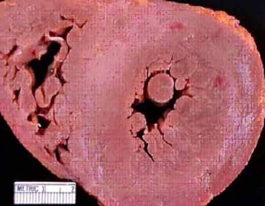 An autopsy specimen that demonstrates cardiac amyloid. The concentric streaks of whitish material in the myocardium represent the “lardaceous change” reported by Von Rokitansky in 1842. Note the dramatic thickening of the interventricular septum (normal is 10 mm).