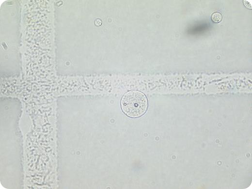 A 50-year-old woman with recently diagnosed stage IV diffuse large B-cell lymphoma had been started on combination chemotherapy. One month later, she presented with a history of progressive neurological symptoms characterized by left hemiparesis and right facial nerve palsy. A manual cell count on a cerebrospinal fluid (CSF) sample revealed a white cell count of 0.006 × 109/L. The white cells had the appearance of malignant lymphocytes. CSF protein was 1.78 g/L (range, 0-0.4 g/L). / A diagnosis of lymphomatous meningitis was made and liposomal cytarabine (DepoCyte) was administered intrathecally. Two weeks later, clinical improvement was noted and further DepoCyte was administered. On that occasion, the CSF white cell count was 0.08 × 109/L. This was an unexpected finding given the clinical improvement. Repeated examination of the CSF revealed that the “white cells” were DepoCyte particles rather than malignant lymphocytes. These particles were not visible on cytospin preparations, either when CSF was spun alone or when it was resuspended in albumin, suggesting that the particles were too fragile to remain intact during cytospin preparation. / Intrathecal DepoCyte is composed of cytarabine held within aqueous chambers and encapsulated by lipid bi-layers. Use of this sustained-release formulation reduces the number of intrathecal injections required. It is important to recognize these particles as spurious elevation of CSF white cell counts, rather than evidence of progressive disease.