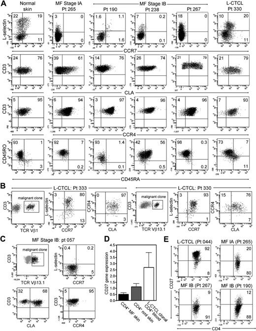 Figure 2. CD4+ T cells from MF skin lesions have an effector memory phenotype, but T cells from L-CTCL skin lesions have central memory characteristics. (A) Normal skin and the skin lesions of patients with L-CTCL contained a clear population of L-selectin and CCR7 coexpressing central memory T cells. However, T cells isolated from the skin lesions of stable patch plaque MF lacked coexpression of the central memory markers CCR7/L-selectin but did express the skin homing addressins CCR4 and CLA. All histograms are gated to show only CD4+ T cells. CCR4 was expressed by virtually all T cells, whereas CLA expression was frequent but not universal. Similar to results in L-CTCL patients, expression of CD45RO and CD45RA varied among patients. Four representative patients are shown; similar results were obtained in a total of 15 patients. (B) Clonal malignant T cells in the skin lesions of patients with L-CTCL expressed both L-selectin/CCR7 and skin homing addressins. Malignant T cells from the skin lesions of patients with L-CTCL were selectively studied by gating on T cells expressing the malignant Vβ subfamily (black cells, Vβ1 for patient 333 and Vβ13.1 for patient 330). Histograms are gated to show only malignant T cells. Malignant clonal T cells showed near-universal expression of the central memory markers L-selectin and CCR7 as well as high expression of the skin homing addressins CLA and CCR4. Results from 2 patients are shown; similar findings were observed in T cells isolated from the skin lesions of 4 additional L-CTCL patients. (C) In contrast, clonal T cells arising in MF skin lesions lacked central memory markers. Clonal malignant T cells expressing TCR-Vβ13.1 were evident in the skin lesions of a patient with MF (black cells represent remaining histograms gated to display only clonal malignant cells). Clonal malignant T cells lacked expression of the central memory markers L-selectin/CCR7 but expressed CCR4, and the majority coexpressed CLA. (D) Microarray gene expression analysis demonstrated that T cells from MF skin lesions expressed low levels of CD27 compared with clonal malignant T cells isolated from the blood of L-CTCL patients. The mean ± SEM of 5 MF patients, 3 normal skin patients, and 3 L-CTCL patients are shown. (E) Flow cytometric staining of T cells from the skin lesions of MF and L-CTCL confirmed that CD4+ T cells in MF show loss of CD27, consistent with an effector memory phenotype. T cells from the skin lesion of a representative patient with L-CTCL expressed CD27.