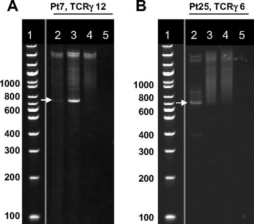 Figure 2. TCRγ rearrangements at the diagnosis and during TKI therapy. Clonality of the lymphocytes was determined by PCR and gel analysis with the use of 12 primer pairs for the TCR γ gene rearrangements and 6 primer pairs for TCR δ gene rearrangements. After PCR amplification and heteroduplex treatment, the PCR products were separated by electrophoresis on a 5% Criterion gel. Gels were stained with EtBr and visualized with ultraviolet illumination. (A) Dasatinib-treated patient with LGL lymphocytosis showing clonal PCR products (white arrow) of the primer pair TCRγ 12 at diagnosis and during dasatinib therapy. Lane 2 indicates at diagnosis; lane 3, 6 months after start of dasatinib therapy during lymphocytosis; lane 4, pool of healthy controls showing polyclonal smear; lane 5, water control. (B) Imatinib-treated patient without lymphocytosis showing clonal PCR product (white arrow) of the primer pair TCRγ 6 at diagnosis. After 12 months of imatinib therapy, no clonal band was visible. Lane 2 indicates at diagnosis; lane 3, 12 months after start of imatinib therapy; lane 4, pool of healthy controls showing polyclonal smear; lane 5, water control. Positive findings were confirmed with sequencing. Vertical lines have been inserted to indicate a repositioned gel lane (DNA ladder).