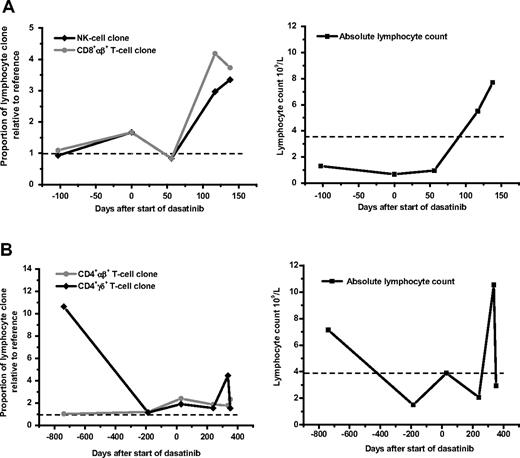 Figure 3. Quantitative follow-up of lymphocyte clone with individual ASO primers. Patient-specific primers were designed to recognize clonal TCR γ and TCR δ gene rearrangements and were used to estimate the amount of clone in various time points before and during dasatinib therapy. The estimation of the amount of the existing clone was determined by designating one follow-up sample with a reference value of 1, and calculating other follow-up samples in relation to this reference sample. Figures on the left side show the estimated amount of clone in the blood at different time points (reference level 1 is marked with dashed black line). The figure on the right side presents the absolute lymphocyte counts at the same time points (upper limit of normal lymphocyte count is marked with dashed black line). (A) Patient 1 (Tables 1,4). This patient had a clonal rearrangement in TCR γ gene that was detected in CD8+αβ+ T cells, whereas the clonal rearrangement in TCR δ gene was found in NK cells. Follow-up of these 2 clones was done before (day −103, on imatinib) and after start of dasatinib therapy (days 56, 117, and 138). (B) Patient 5 (Tables 1,4). This patient had a clonal rearrangement in TCR γ gene detected in CD4+αβ+ T cells, whereas the clonal rearrangement in TCR δ gene was found in CD4+γδ+ T cells. Follow-up samples were available from the time of diagnosis (day −739) and during imatinib (day −187) and dasatinib (days 29, 239, 336, and 351) therapy.