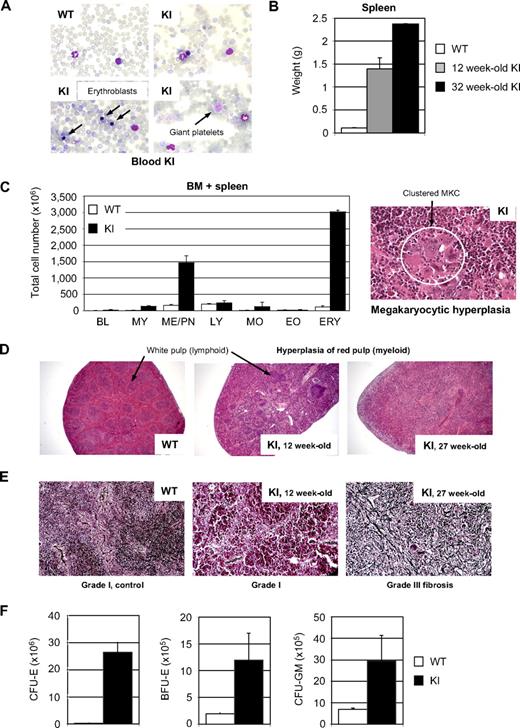 Figure 2. Blood, BM, and spleen features from Jak2V617F KI mice. (A) Blood smears from a 31-week-old Jak2V617F KI mouse revealed RBC polychromatophilia, anisocytosis and poikilocytosis, large platelets, and erythroblastosis (May-Grünwald-Giemsa staining). Images were obtained (63× lens) using a Zeiss Axiophot microscope with a Zeiss AxioCam Mrc camera and AxioVision Rel.4.3 acquisition software. (B) Spleen weight in KI mice proportionally increased with age (mean value ± SD, n = 3). (C) Myeloid trilineage hyperplasia in KI mice. The left panel shows no blockade in the differentiation processes and increases in the cumulative numbers (BM plus spleen) of granulocytic and erythroid precursor cells in KI compared with WT mice (mean value ± SD, n = 2, 27 and 31 weeks old). Calculation is based on the assumption that 1 femur represented 6% of the total marrow and from the number of cells isolated from the spleen. Cell types were identified from May-Grünwald-Giemsa stained cell cytospins. BL indicates blast; MY, myeloblast/myelocyte; ME/PN, metamyelocyte/polymorph; LY, lymphocyte; MO, monocyte; EO, eosinophil; and ERY, erythroblast. The right panel shows clustered megakaryocytes (MKs) with multilobulated nucleus from a hematoxylin/eosin/safran (HES)–stained KI mouse spleen (400× magnification). Images were obtained using a DM2000 Leica microscope and a DFC300FX Leica camera with Leica Application Suite v.2.5,OR1 acquisition software. (D-E) Histology of the spleen. (D) Hematoxylin-eosin coloration of a 12-week-old KI mouse revealed hyperplasia of the red pulp with the partially preserved white pulp that was clearly visible in a WT mouse (arrows). In contrast, white pulp of a 27-week-old KI mouse was completely blended. (25× magnification). (E) Silver stain coloration indicated high-grade fibrosis in a 36-week-old mouse. Fibrosis was absent in 12-week-old KI and 27-week-old WT mice (200× magnification). (F) Cumulative numbers of progenitor cells in BM and spleen from KI and WT mice scored after 2 (CFU-E) or 7 (BFU-E and CFU-GM) days of culture (mean value ± SE, n = 4, 21 ± 5 weeks of age). WT littermates were usually used as controls.