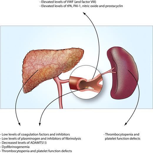 Figure 1. Causes of the hemostatic changes in patients with liver disease. The multiple changes that either reduce or promote hemostasis can be attributed to 4 mechanisms. (1) A reduced synthetic capacity of the liver results in decreased levels of many proteins involved in hemostasis. Moreover, decreased hepatic synthesis of thrombopoietin contributes to thrombocytopenia. (2) Systemic intravascular coagulation results in consumption of platelets and hemostatic factors. (3) Systemic activation of endothelial cells results in increased release or production of hemostatic factors. (4) Increased platelet pooling in the enlarged spleen may contribute to thrombocytopenia.