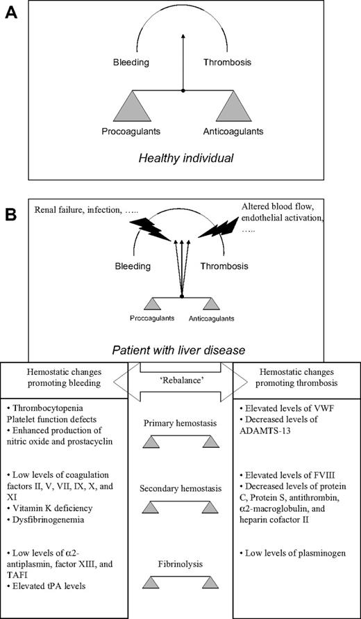 Figure 2. The concept of rebalanced hemostasis in patients with liver disease. In healthy persons (A), hemostasis is in a solid balance. In patients with liver disease (B and table), concomitant changes in pro- and antihemostatic pathways result in a “rebalance” in the hemostatic system. Rebalance in the hemostatic system occurs at the level of primary and secondary hemostasis, and in the fibrinolytic system. This new balance, however, presumably is less stable compared with the balance in healthy volunteers, and may thus more easily tip toward either bleeding or thrombosis. Modified from Warnaar et al69 with permission from Wolters Kluwer Health.