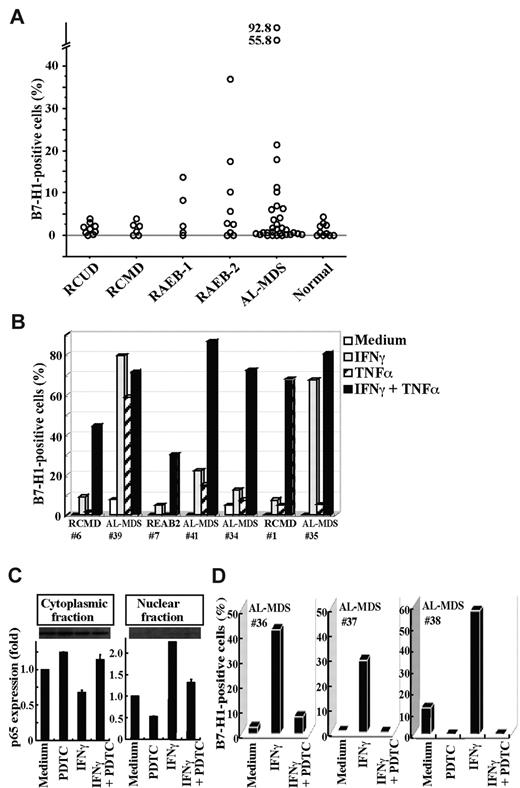 Figure 5. B7-H1 expression on patient blasts. (A) The percentages of B7-H1+ cells in blasts from freshly isolated bone marrow samples. (B) The induction of B7-H1 expression on blasts from 7 patients. The cells had been cultured for 2 days with IFNγ and/or TNFα. (C) Purified CD34+ blasts from a patient (no. 38) were incubated with no additive (Medium), PDTC (100μM), IFNγ, or IFNγ and PDTC. After incubation, the blasts were separated into cytoplasmic and nuclear fractions. The NF-κB p65 contents in each fraction were analyzed using Western blotting to show representative (top panel) and quantified (bottom panel) data (mean + SD) of 2 experiments. In each experiment, the band intensity of cell fractions from blasts that had been cultured with no additive was defined as 1. (E) The inhibitor of NF-κB, PDTC, blocked B7-H1 induction by IFNγ on patient blasts. Purified CD34+ blasts from patients were cultured as indicated, and their B7-H1 expression was analyzed.