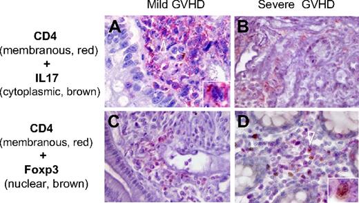 Figure 1. Th17 and Treg distribution in gut biopsies of patients with mild and severe GVHD. Th17 and Treg were identified by the expression of IL-17 or Foxp3, respectively, in CD4+ cells using 2-color immunohistochemistry (A-B, IL-17 in brown; C-D, Foxp3 in brown; A-D, CD4 in red). Th17 cells were more numerous in patients with mild GVHD (A arrowhead), whereas Treg were present in patients with severe GVHD (D arrowhead). Counts of double-immunostained cells were independently assessed by 2 pathologists (P.R. and A.J.) on an Olympus AX 70 microscope with wide-field eyepiece number 26.5. At 400× magnification, this wide-field eyepiece provided a field size of 0.344 mm2.