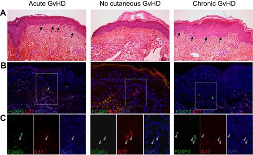 Figure 4. Double immunofluorescent staining with IL-17 and Foxp3 in skin biopsies of patients with acute, chronic, and no GVHD. (A) Skin biopsies showed infiltrates and apoptotic bodies (arrows) in acute and chronic lichenoid eruption but not in patients without GVHD. (B) Overlay of double immunofluorescent staining with IL-17 (red) and Foxp3 (green) antibodies showed Foxp3 expressing cells in skin biopsies of patients with acute and chronic GVHD and IL17-expressing cells in skin biopsies of patients without GVHD. (C) Enlargement of the stained cells showed that none of them expressed both IL-17 and Foxp3.