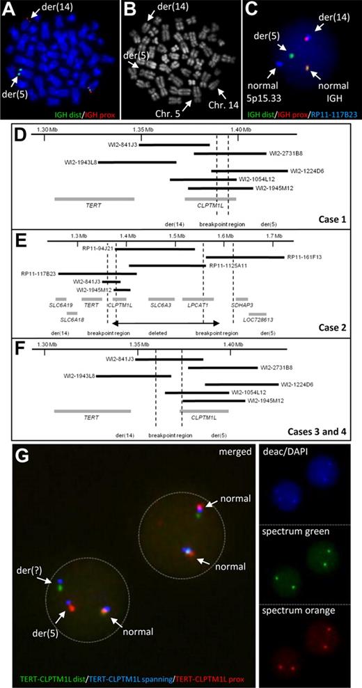 Figure 1. Characterization of chromosomal aberrations affecting the TERT-CLPTM1L locus. IGH FISH (A) and R-banding analysis (B) of the same metaphase of case 1 showing the cytogenetic cryptic t(5;14). (C) Interphase FISH showing a fusion of IGH and the TERT-CLPTM1L locus in case 1. (D-F) Schematic maps of the breakpoint regions in cases with t(5;14)(p15;q32) based on FISH mapping. Black bars indicate the hybridized BAC and Fosmid clones; gray bars represent the genes in the region. The breakpoint regions were determined by the respective FISH hybridization patterns. (G) FISH using the TERT-CLPTM1L 3-color break-apart assay on MCL case 10 showing break in the clone RP11-117B23 (blue signal). The R-banding image with Chromomycin A3 (C2659, Sigma-Aldrich) and Methyl green (M8884, Sigma-Aldrich) was obtained using a 63×/1.40 numeric aperture oil objective in a Zeiss Axioskop Imager M1 fluorescence microscope (Zeiss) with R-banding filter sets (Zeiss) and documented using the IKAROS imaging system version 5.2.11 (MetaSystems). FISH images were acquired using a 63×/1.40 numeric aperture oil objective in a Zeiss Axioskop 2 fluorescence microscope (Zeiss) equipped with the appropriate filter sets (AHF) and documented using a CV-M300 camera (JAI Corporation) and the ISIS imaging system Version 5.2.11 (MetaSystems). dist indicates distal; and prox, proximal.