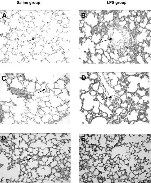 Figure 1. Effect of transfusion of aged platelets on lung injury in healthy and primed rats. Histologic sections of hematoxylin and eosin stained rat lungs at 20× magnification. (A) Saline control; (B) LPS control; (C) saline plus fresh PLTs day 0; (D) LPS plus PLTs day 0; (E) saline plus aged PLTs (PLTs day 5); (F) LPS plus PLTs day 5. Normal vasculature (arrows, panels A and C) neutrophils sequestrated in the vasculature (arrows, panels B,D,F).