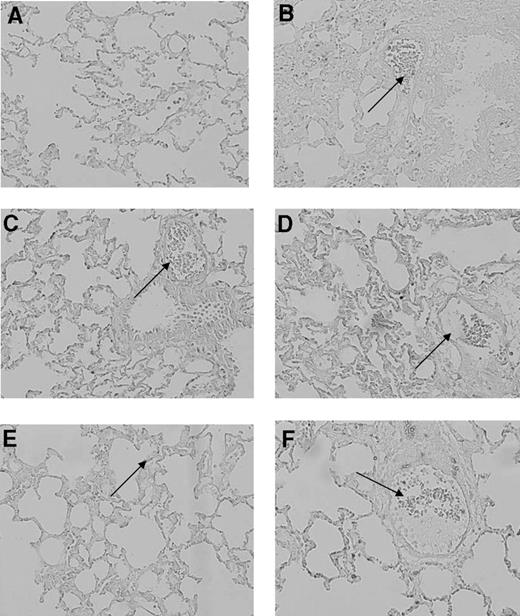 Figure 4. Effect of transfusion of aged platelets on CD40L expression in lung tissue. Histologic sections of CD40L stained rat lungs at 20× magnification. (A) saline control; (B) LPS control; (C) saline plus fresh PLTs day 0; (D) LPS plus PLTs day 0; (E) saline plus aged PLTs (PLTs day 5); (F) LPS plus PLTs day 5. CD40L is indicated by brown staining. In all sections, except for the saline-negative control, CD40L staining is present on pulmonary T cells and on the endovascular wall (arrows).