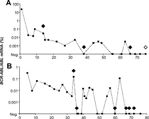 Figure 1. Representative patterns of residual disease found in IM-treated patients achieving CMR. Panels A and B show 2 individual patients. On the x-axis are months on imatinib (IM). The results of the quantitation of BCR-ABL transcripts (■) are expressed as the ratio of BCR-ABL to ABL mRNA (y-axis, in a logarithmic scale). The results of the real-time quantitative polymerase chain reaction for gBCR-ABL are represented as diamonds: ♦, gBCR-ABL–positive; ◆, gBCR-ABL–negative. (A) gBCR-ABL was initially detected in transcript-negative samples but became undetectable with continuing IM therapy. A similar pattern was seen in 3 other patients tested. (B) The single patient, of 5 tested, in which all transcript-negative samples tested were gBCR-ABL–positive.