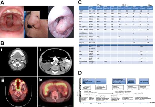 Figure 1. Granulomatous inflammation and immunophenotype on Subject P. (A) Photographs of palatal fistula at initial presentation (left), nasal fistulous tract with collapse of left alar rim (middle), and inflamed epiglottis (right). (B) Imaging studies with the use of computed tomography show the marked subglottic stenosis characteristically seen in WG (i) and megacolon (ii). Extensive inflammation in the nasopharynx (iii) and colon (iv) was evident on positron emission tomographic scans. (C) A summary of lymphocyte, immunoglobulin, and antibody levels at chronologic time points from initial diagnostic work up. *Patient on γ globulin supplement. The normal range referenced the values within 95% confidence interval, n = 40. (D) A time line depicting patient P's major clinical events chronologically (the time line is not to scale) and the progression of provisional diagnoses.