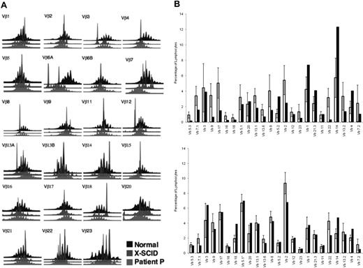 Figure 2. Diversity of T-cell receptor repertoire. (A) A diverse distribution of CDR3 lengths in most of the Vβ families was observed in the spectratype of patient P (red) compared with a healthy control (black), whereas a partially corrected γc-deficient severe combined immunodeficient patient (blue) displayed an oligoclonal repertoire. (B) Quantitative analysis of Vβ distribution in CD4+ and CD8+T (C) cells showed some under-presentation in a few Vβ families and over-represented in others, particularly in CD8+ T cells. The shaded bars represent the patient's cells. The error bars indicate ± 1 SD.