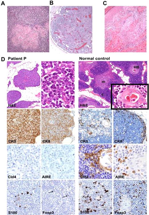 Figure 3. Immunohistopathology of lymph node, skin, and thymus. (A) Lymph node biopsy from patient P shows preserved nodal architecture with well-formed secondary B follicles and multiple epithelioid granulomas with multinucleated giant cells in the paracortical area. In contrast, lymph node at autopsy from patient's sister showed no secondary B follicles and marked polyclonal plasmacytosis (B). (C) Skin biopsy (heel) shows dense granulomatous inflammation involving mid dermis around vessels, clusters of epithelioid cells, and multinucleated giant cells. (D) Thymic biopsy shows abnormal thymic architecture with loss of corticomedullary demarcation (CMD), fat replacement and absence of Hassal bodies (HBs); moderate number of thymocytes, mostly of a blastic immature phenotype, and are admixed with TECs (top left). Immunostains highlight a diffuse epithelial network mostly composed of cytokeratin-5+cytokeratin-8− (CK5+CK8−) double-positive immature TECs and no expression of Cld4 and AIRE (middle left). In contrast, normal thymus shows defined CMD and presence of HBs (top right and inset) with normal distribution of CK5+CK8− and CK5−CK8+ single-positive cortical (c) and medullary (m) TECs, with expression of claudine-4 (Cld4) and AIRE (middle right). Severe depletion of thymic S-100+ DCs and Foxp3+ regulatory T cells (Tregs) are seen in patient (bottom left), whereas normal distribution of medullary S-100+ DCs and Foxp3+ Tregs were present in control thymus (bottom right; Foxp3+ cells are indicated by arrows). Hematoxylin and eosin (H&E) staining, 4×, 40× (inset), and 60× original magnification; immunostains for CK5, CK8, S-100, and Foxp3, 20× magnification; immunostains for Cld4 and AIRE, 40× magnification.