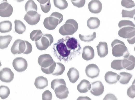 A 29-year-old patient was admitted to the intensive care unit with fulminant septic shock leading to multiorgan failure and diffuse intravascular coagulation (DIC). He had seriously injured both hands with open wounds after a fall from his bicycle 3 days earlier. His medical history included splenectomy after trauma 3 years earlier. The peripheral blood smear revealed granulocytes with multiple intracellular rod-shaped bacilli (see figure). Also seen is a Howell-Jolly body and an absence of platelets. The platelet count was 13 × 109/L and the coagulation tests were prolonged, consistent with DIC. Howell-Jolly bodies might have been related to the previous splenectomy, the serious infection, or both; however, they persisted after recovery, suggesting that they were related to the previous splenectomy. / A determination by the microbiologist indicated that the granulocytic inclusions were Capnocytophaga canimorsus. Broad-spectrum antibiotics were replaced by penicillin and the patient recovered. Further information revealed that his sister's dog had licked his wounded hands 2 days before the admission. The canine oral cavity is a well-known reservoir of this pathogen, which can cause life-threatening infections in splenectomized patients.