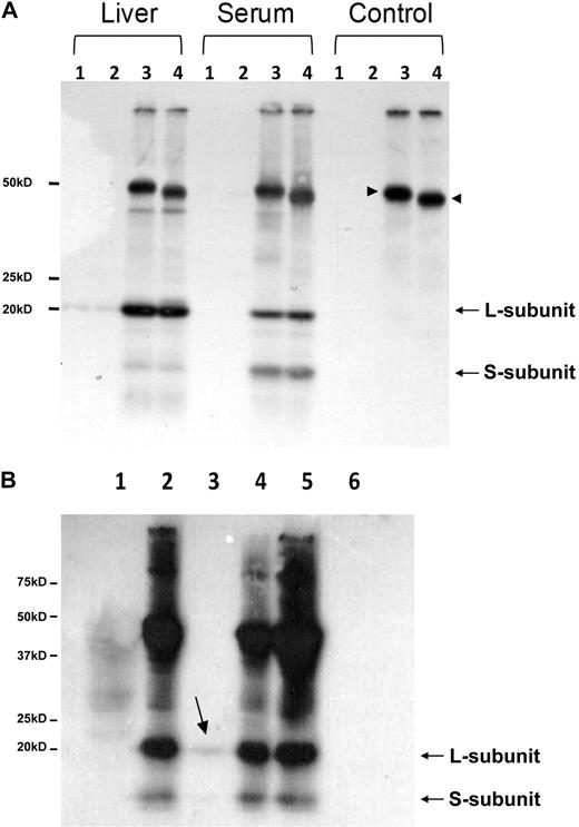 Figure 4. Mouse serum ferritin is not detectably glycosylated. (A) Deglycosylation of immunoprecipitated liver and serum ferritin from iron-overloaded mice with Peptide: N-Glycosidase F (PNGase-F) followed by separation on SDS-PAGE and Western blot with an anti–mouse liver ferritin antibody. Lanes 1 and 2 are pre-clears before and after deglycosylation, respectively. Lanes 3 and 4 are immunoprecipitated samples before and after deglycosylation, respectively. No change in molecular weight was detected in L- ferritin subunit after PNGase F digestion. Note the significant amount of the S-subunit detected in serum, compared with liver ferritin. An internal positive control is marked with arrowheads and shows that IgG heavy chain was successfully deglycosylated (1 representative experiment is shown of 5). (B) ConA binding of mouse serum ferritin. Serum was incubated with protein A sepharose and with ConA beads (lanes 1 and 3, respectively) and their supernatants were immunoprecipitated with anti–liver ferritin antibody (lanes 2 and 4). Serum was directly immunoprecipitated with anti–liver ferritin antibody (lane 5) and ConA beads were loaded in lane 6. All samples were analyzed on SDS-PAGE followed by Western blot analysis (1 representative experiment is shown of 5).