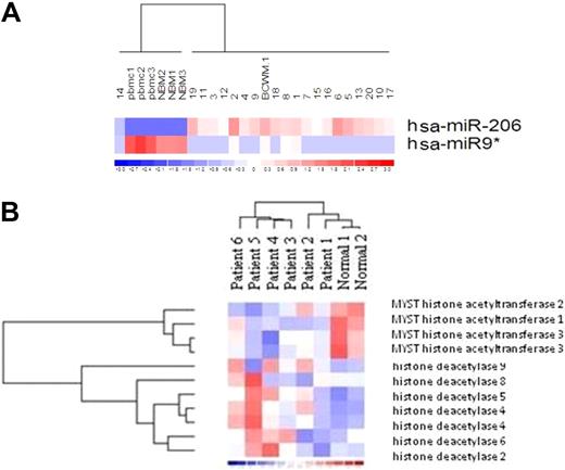 Figure 1. Primary WM cells present with higher level of miRNA-206, lower level of miRNA-9*, together with increased expression of HDACs and reduced expression of HATs, compared with healthy donors. (A) miRNA analysis has been performed on total RNA isolated from BM CD19+ WM cells, normal bone marrow (NBM)– and PBMC-derived CD19+ counterparts, and WM cell line (BCWM.1). Heatmap was generated after supervised hierarchical clustering analysis was performed with analysis of variance test. Differential expression of miRNA patterns is shown by the intensity of red (up-regulation) versus blue (down-regulation). (B) Purified cRNA (15 μg) isolated from primary CD19+ cells isolated from BM of 6 patients with WM and from CD19+ cells isolated from PBMCs of 2 healthy donors was hybridized to HG-U133Plus2.0 GeneChip (Affimetrix). Fold change is shown by the intensity of induction (red) or suppression (blue).