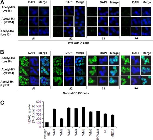 Figure 2. Lower expression of acetylated histone-3/histone-4 and higher HDAC activity characterize primary WM cells compared with healthy donors. Immunocytochemical analysis of primary CD19+ cells isolated from BM of 4 patients with WM (A) and CD19+ cells isolated from PBMCs of 4 healthy donors (B) was performed with the use of anti–acetyl-histone-H3 (Lys18), -H3 (lys9/14), and -H4 (lys12) antibodies. DAPI (4′-6′-diamidine-2-phenylindole) was used to stain nuclei. (C) HDAC activity was assessed with nuclear extracts with the use of a Colorimetric HDAC Activity Assay Kit on primary CD19+ cells isolated from BM of 6 patients with WM (WM1, WM2, WM3, WM4, WM5, WM6); primary CD19+ cells were isolated from PBMCs of 3 healthy donors (average HD), and BCWM.1 and low-grade lymphomas IgM-secreting cell lines (all P ≤ .05).
