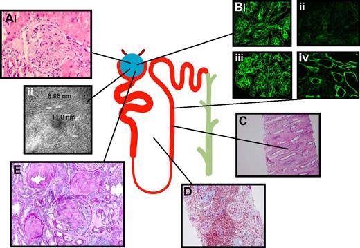 Figure 1. Three distinct syndromes account for most cases of Ig-mediated kidney disease but virtually all nephropathologic syndromes have been observed. Panel A shows amyloid. (i) Amyloid fibrils consisting of monoclonal Ig and serum proteins appear here as pink material disrupting glomeruli architecture. (ii) Amyloid is visible on electron microscopy as 7- to 12-nm fibrils. Panel B shows MIDD. Monoclonal light chains kappa (1) or without evidence of lambda (ii) and/or heavy chains (IgG), deposit along glomerular (iii) and tubular basement membranes (iv), altering the glomerular structure and causing dose-dependent proximal tubular toxicity. Panel C shows cast nephropathy. Filtered monoclonal Ig, Tamm-Horsfall, and other proteins form casts, which obstruct tubules and collecting ducts. Casts can rupture and result in interstitial inflammation. Panel D shows interstitial inflammation. Inflammation also results from the processing of filtered monoclonal light chains, which induces NF-κB and other signaling pathways leading to cytokine-mediated inflammatory infiltrate (shown here with a Trichrome stain) and subsequent matrix deposition and fibrosis. Panel E shows glomerular crescent. Virtually every recognized nephropathologic lesion has been described in association with paraproteinemia. Shown here is a glomerular crescent in a patient with Waldenström macroglobulinemia productive of IgMλ and amyloidosis.