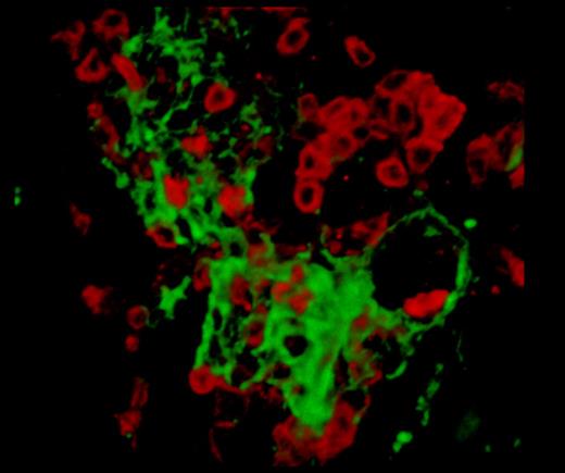 A single frame captured from supplemental Video 1 (Connolly et al1), showing the inflammatory lesions in PlauGFDhu/GFDhu mice. T lymphocytes (red, CD3 stain) surround a central core of fibrin (green).