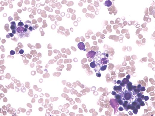 A 7-year-old girl with relapsed acute lymphoblastic leukemia had been the recipient of an unrelated donor marrow transplant 8 months earlier. After a course of dexamethasone, mercaptopurine, and methotrexate, her marrow showed a morphologic remission with 100% donor chimerism. Noteworthy were the presence of numerous erythroblastic islands (pictured). / Erythroblastic islands are rosettes consisting of a centrally located macrophage surrounded by at least one layer of developing red cell precursors. Each precursor has intimate contact with the macrophage cytoplasm. The central macrophage, termed a “nurse” cell, may support developing red cells by providing required recycled hematinics and by preventing apoptosis of the precursors via adhesive interaction between very late activation antigen 4 and vascular cell adhesion molecule 1. The excess of such islands in this case may reflect a sign of erythropoietic stress related to relative increase in sensitivity of donor hemopoiesis to thiopurine and antifolate therapy. / Previously reported to www.bloodmed.com as: “Case study Images 190: Erythroblastic islands following treatment of acute lymphoblastic leukemia.”