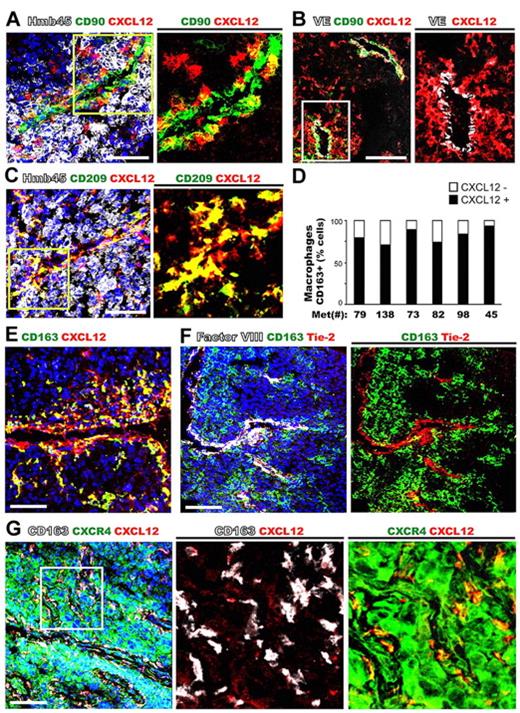 Figure 4. Most CXCL12+ cells in metastatic melanoma tissues are CD209+ and CD163+ tumor-associated macrophages that display a perivascular location and express CXCR4. Metastatic melanoma tissues were stained with anti-CXCL12 and the following tissue markers: (A) melanocytic cells (HMb45) and myofibroblasts (CD90); (B) endothelial cells (VE-cadherin, VE) and myofibroblasts (CD90); (C) macrophages (CD209) and melanocytic cells (HMb45); and (D) quantification of CXCL12 expression in macrophages CD163+ was given as percentage. Several melanoma metastases were analyzed: #45 lung metastasis; #73, 79, 82, and 138 lymph node metastasis; and #98 skin metastasis. (E) Macrophages (CD163). (F) Macrophages (CD163), endothelial cells (Factor VIII), and TIE-2 positive cells. (G) Macrophages (CD163) and CXCR4+ cells (tumor and macrophages).