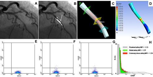 Figure 1. Representative patient. (A) Coronary angiogram showing a lesion in the mid left anterior descending artery. (B) Two-dimensional quantitative coronary angiography showing 52% DS (arrow). (C) Three-dimensional quantitative coronary angiography showing cross-sectional area stenosis (CS) of 62% and lesion length of 12.25 mm. (D) Shear stress map generated from flow field calculated by computational fluid dynamics analysis, showing peak wall shear stress of 33.1 Pa. (E-G) Flow cytometry density plot of platelet CD62P expression in the coronary artery proximal (E) and distal (F) to the lesion, and in the coronary sinus (G). (H) Histogram overlay of platelet CD62 expression in the 3 sites. MFI indicates mean fluorescence intensity.