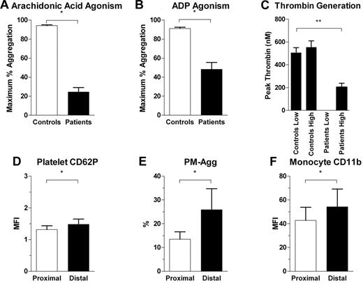 Figure 9. Platelet and leukocyte activation in the presence of heparin and high doses of aspirin and clopidogrel. Comparison of levels of platelet aggregation between healthy controls and subjects on antiplatelet agents for (A) arachidonic acid and (B) ADP-induced maximum percentage of platelet aggregation. (C) Thrombin generation induced by low and high concentrations of phospholipids in controls and patients on heparin. Patients on heparin had undetectable low phospholipid dose-induced thrombin generation. **P < .05 for 1-way analysis of variance between groups and post hoc Tukey test between patient and control groups and between patient groups subjected to low and high doses of phospholipid-induced thrombin generation. (D-F) Comparison between proximal and distal coronary site for levels of platelet CD62P, PM-Agg, and monocyte CD11b. *P < .05. Solid bars and error bars represent mean ±SD.