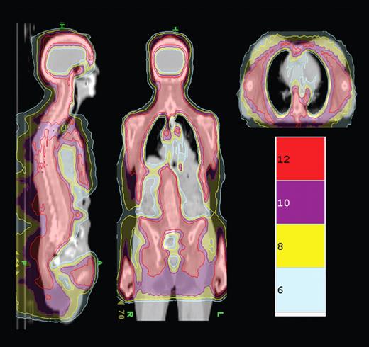 Figure 1. TMLI isodose distribution shows the colorwash isodose distribution of a patient receiving 12 Gy TMLI. Representative sagittal, coronal, and axial planes. Isodose distributions for 12, 10, 8, and 6 Gy are shown.