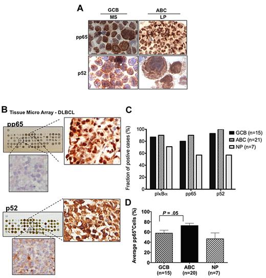 Figure 2. Immunohistochemical analysis of NF-κB components in DLBCL cell lines and primary DLBCL samples. (A) Representative GCB-like (MS) and ABC-like (LP) DLBCL cell lines were used for immunohistochemical staining for pp65 and p52. (B) Representative immunohistochemical analysis of DLBCL tissue arrays of 43 primary DLBCL biopsies with high/low p52, and high/low pp65. Tissue arrays with duplicate samples were scored using an automated analysis system for percentage of positive cell staining for p-IκBα and for the presence of the NF-κB components, pp65 and p52 (supplemental Figure 1). (C) Prevalence of cases that are positive (> 30% staining) for pIκBα, pp65, and p52 in the DLBCL subgroups GCB, ABC, and non-profiled (NP). (D) Analysis of pp65 expression (average of pp65-positive cells) in the DLBCL subgroups GCB, ABC, and non-profiled (NP).