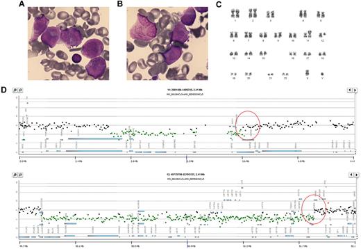 Figure 1. Morphologic features and results of CGH array of an acute myeloid leukemia patient with a clonal translocation t(11;12)(p15;q13) resembling the classical hypergranular subtype of acute promyelocytic leukemia. May-Grümwald-Giemsa–stained bone marrow smear (1000×, Nikon Eclipse 80i microscope and Nikon DS-Fi 1 camera) showing (A) promyelocytes with hypergranulated cytoplasm; several nuclei are invaginated and (B) promyelocyte with bundles of Auer rods (faggot cell). (C) Representative karyotype of BM cells with t(11;12)(p15;q13). (D) Results of CGH array. Top, microdeletions in chromosome 11p15 involving the NUP98 gene. Bottom, microdeletions in chromosome 12q13 involving the RARG gene.