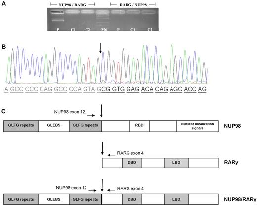 Figure 2. Electrophoresis agarose gel and chromatogram showing the NUP98/RARG rearrangement, and schematic representation of the NUP98/RARG fusion protein. (A) NUP98/RARG fusion. The reciprocal RARG/NUP98 fusion product was not detected. (B) Nucleotide and protein sequences surrounding the NUP98/RARG fusion region. The fusion was in-frame, so that the open reading frames of both genes in the fusion transcript were retained. The arrows indicate the break-point and fusion sites of the NUP98/RARG gene. (C) Schematic representation of the NUP98/RARG fusion proteins and its wild-type counterparts. The locations of the primers used for RT-PCR are indicated by horizontal arrows. GLFG repeats have been shown to be docking sites for transport receptors. P indicates patient cDNA (881bp); C1 and C2, PML/RARA patient's cDNA; M6, molecular weight; GLEBS, motif of nuclear export of poly(A)+ RNA and nuclear pore complex (NPC) structure; RBD, RNA-binding domain; DBD, In the abbreviations for Figure 2, “DBD, DNA-binding domain and distribution and arrows the joining site” has been rephrased as “DBD, DNA-binding domain. Arrows indicate the joining sites.” Please confirm or correct. DNA-binding domain. Arrows indicate the joining sites.