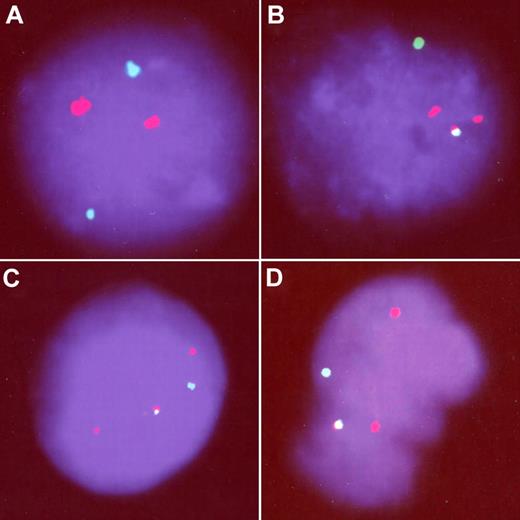 Figure 1. FISH analysis of TEL/AML1-positive cord blood. One negative (A) and 3 TEL/AML1-positive (B-D) cells. All the positive cells show the TEL/AML1 fusion signal (yellow), presence of the nontranslocated TEL allele (green), and 2 red signals demonstrating 1 normal AML1 and 1 signal from the disrupted AML1 allele.